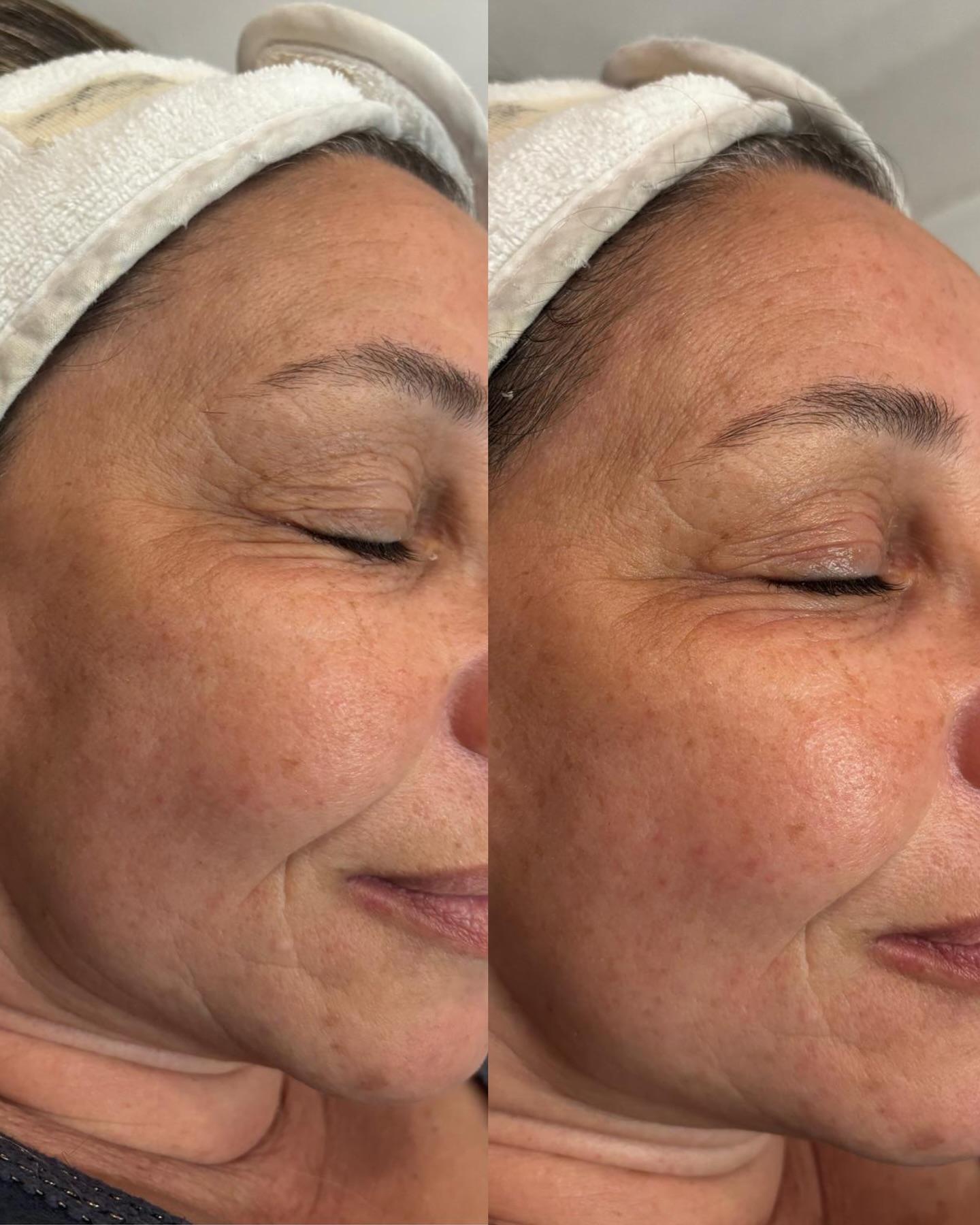 Avant/apr&egrave;s Traitement de peau